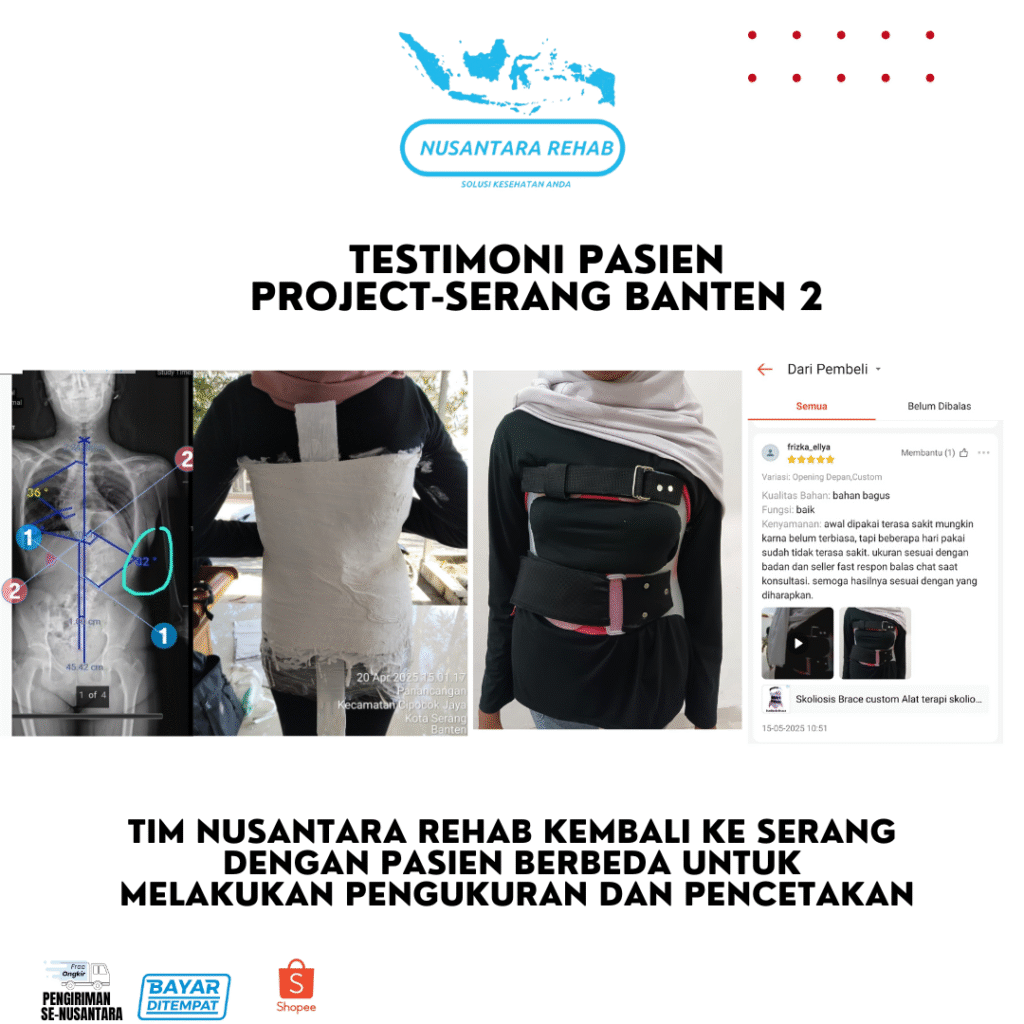 SKOLIOSIS BRACE NUSANTARA REHAB
