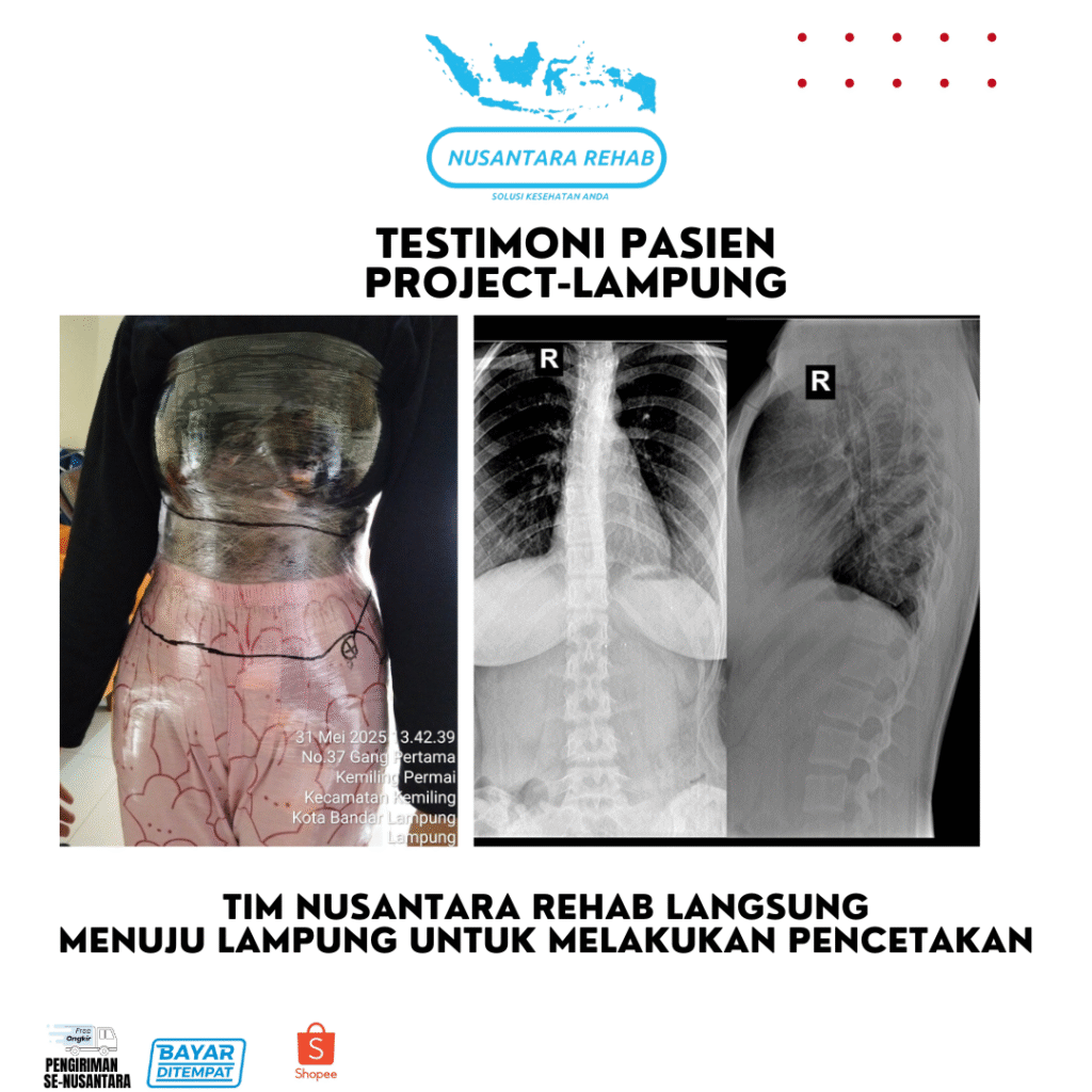 SKOLIOSIS BRACE NUSANTARA REHAB