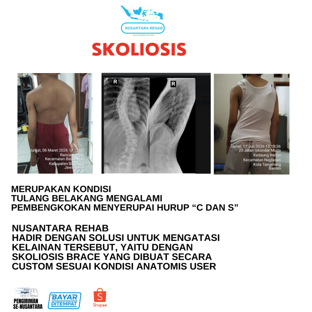 Skoliosis Brace Nusantara Rehab