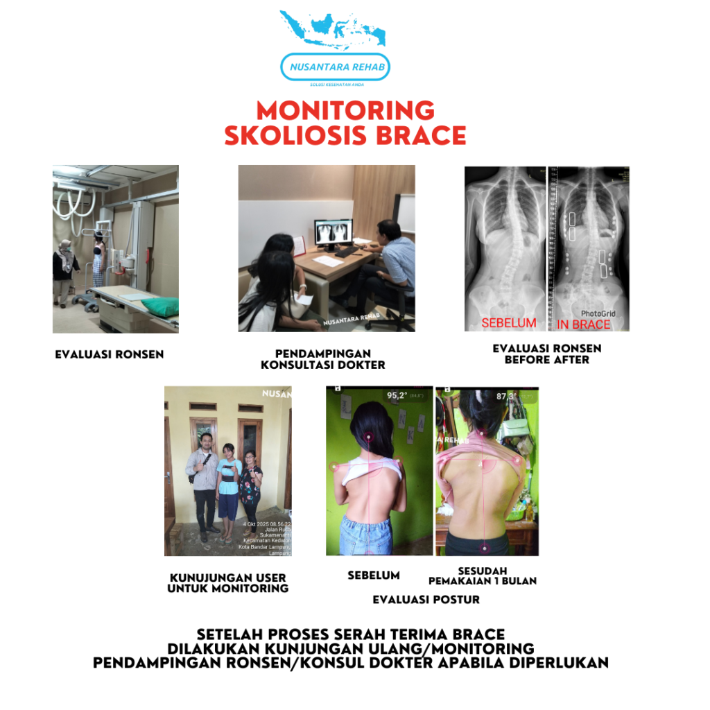 Skoliosis Brace Nusantara Rehab