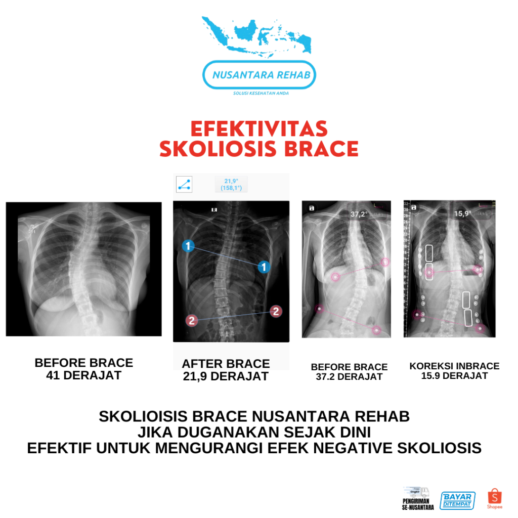 Skoliosis Brace Nusantara Rehab
